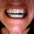 Invisalign Community Photo